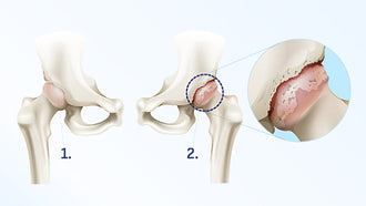 Arthrose